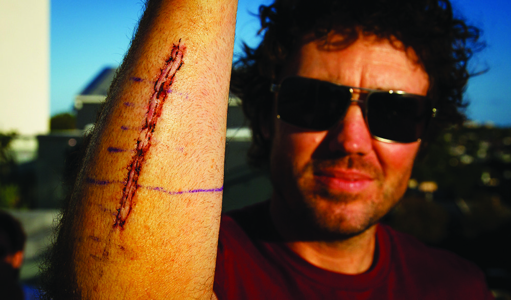 Ski insurance injury